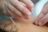 Akupunktur in Mömbris bei chronischen Schmerzen